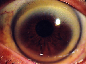 眼科の症状