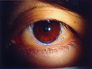 目薬 結膜 浮腫